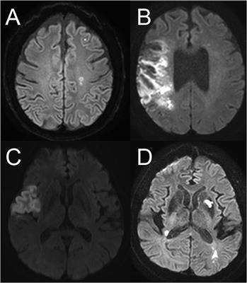 Impact of Neuroimaging Patterns for the Detection of Atrial Fibrillation by Implantable Loop Recorders in Patients With Embolic Stroke of Undetermined Source